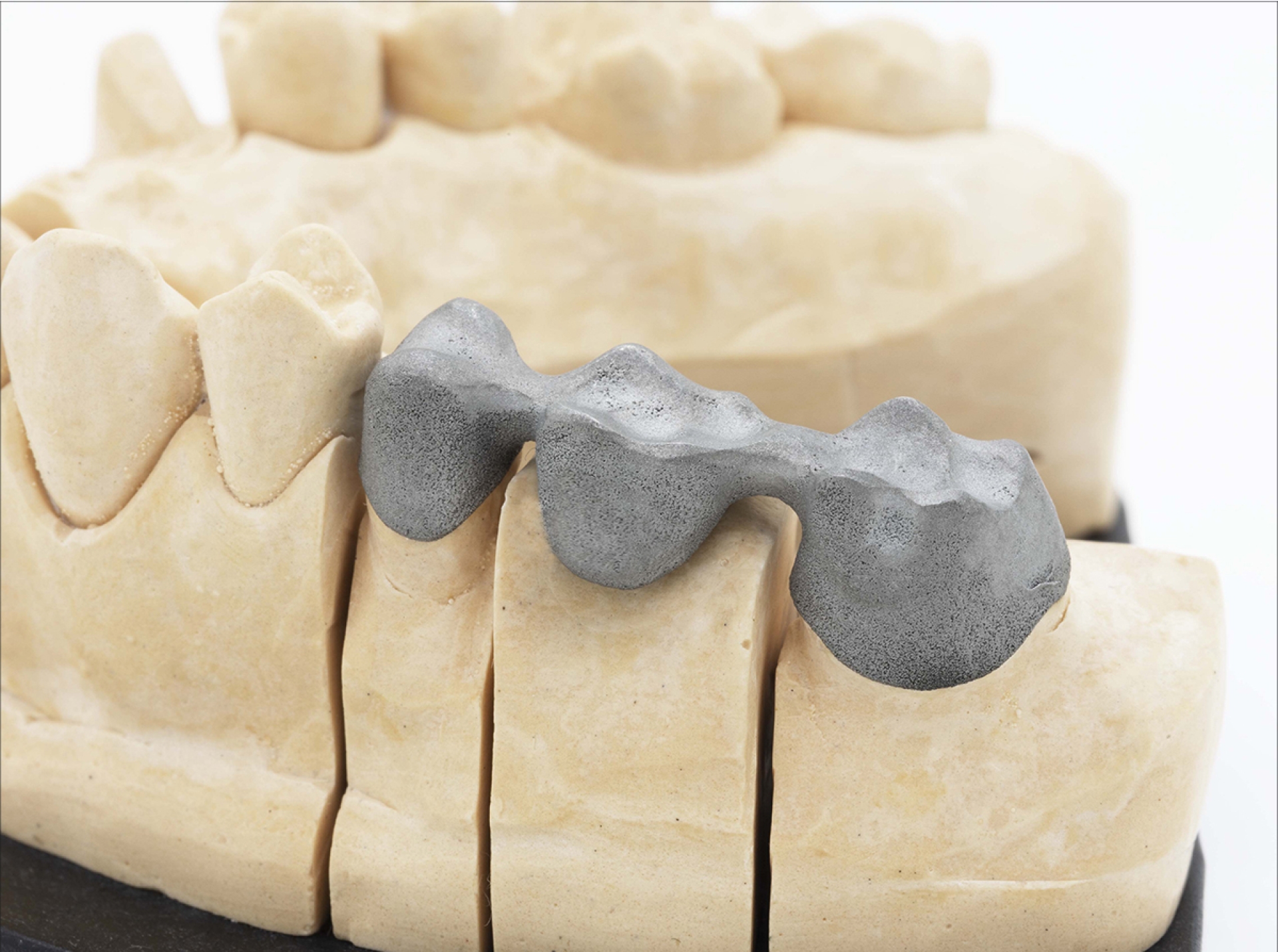 laser-melting-dentale-cromo-cobalto-titanio-rifinito-yndetech