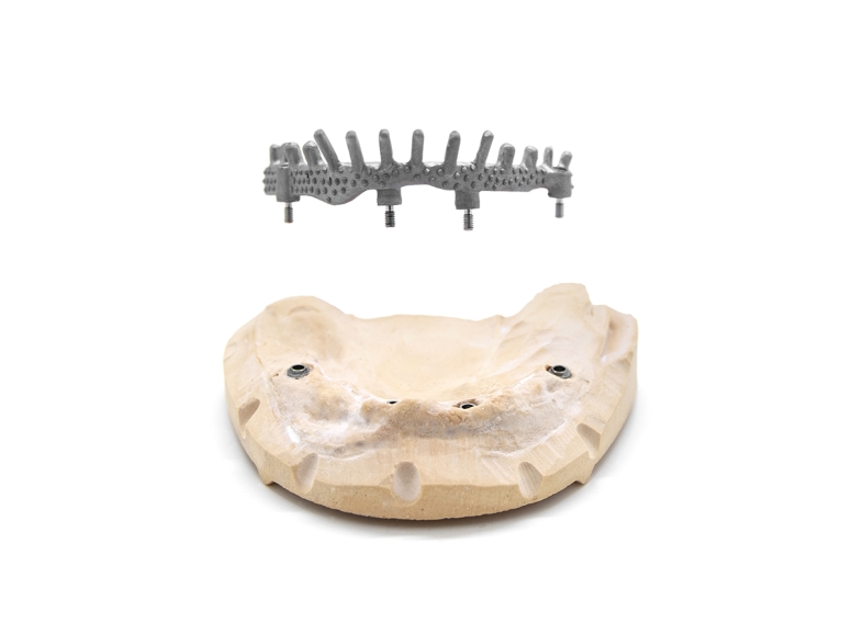 protesi-fissa-impianti-dentali-laser-melting-yndetech